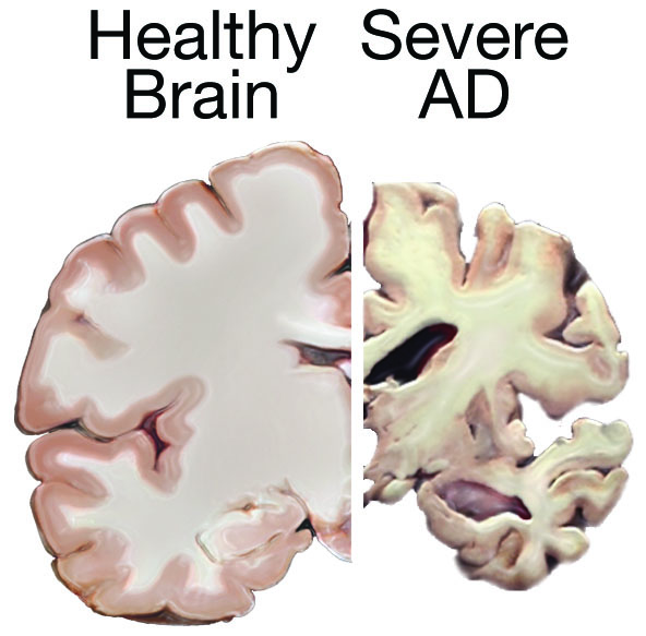 This graphic, produced by the National Institute on Aging, demonstrates the effects of Alzheimer’s disease on the brain, and is one piece of information the coalition is sharing with community members.